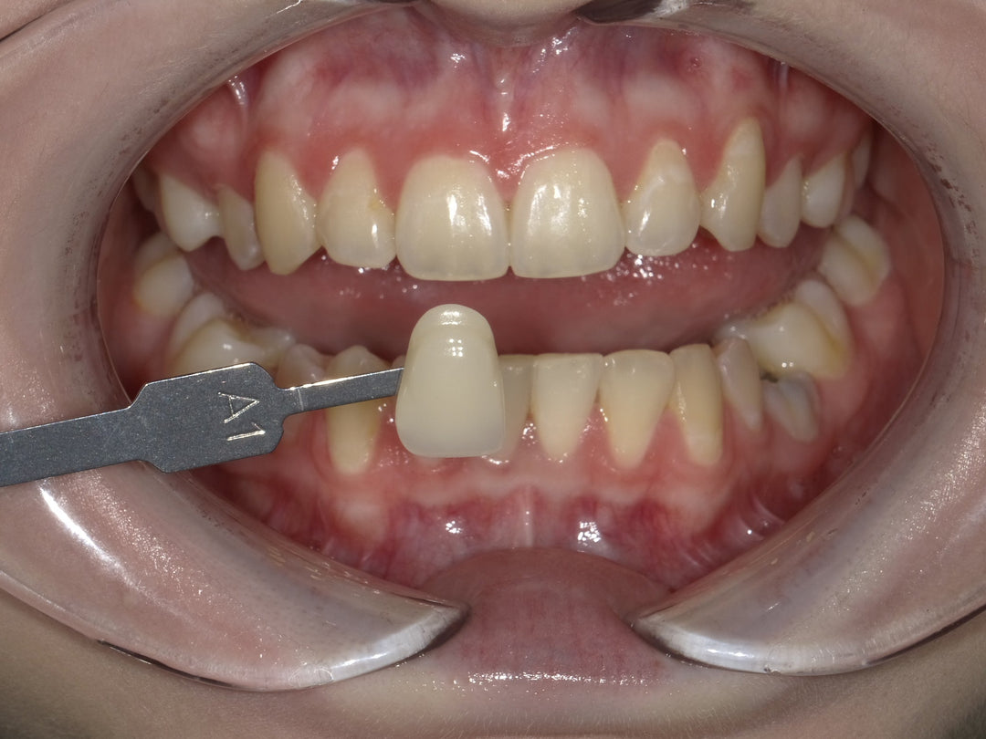 Whitening Relapse and why?