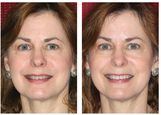 Benefits Of A Brighter Smile