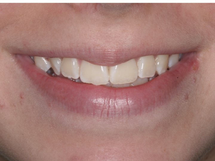 VivaStyle Teeth Whitening Strips