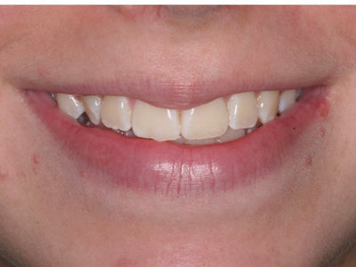 VivaStyle Teeth Whitening Strips