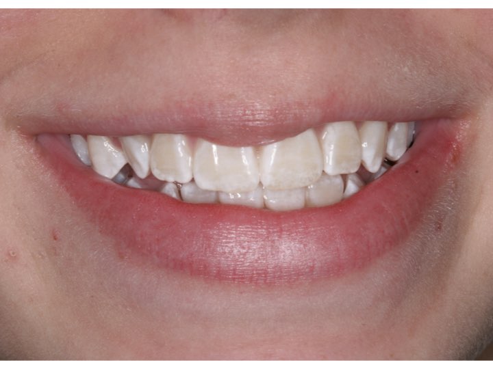 VivaStyle Teeth Whitening Strips