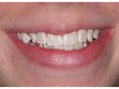 VivaStyle Teeth Whitening Strips